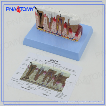PNT-0528ad educational Osteoporosis Diseased Dental Teeth Model